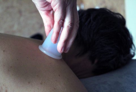 Cupping